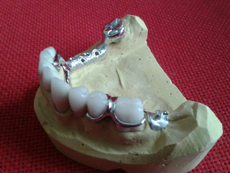 XG Dental - Οδοντοτεχνικό εργαστήριο - Θεσσαλονίκη