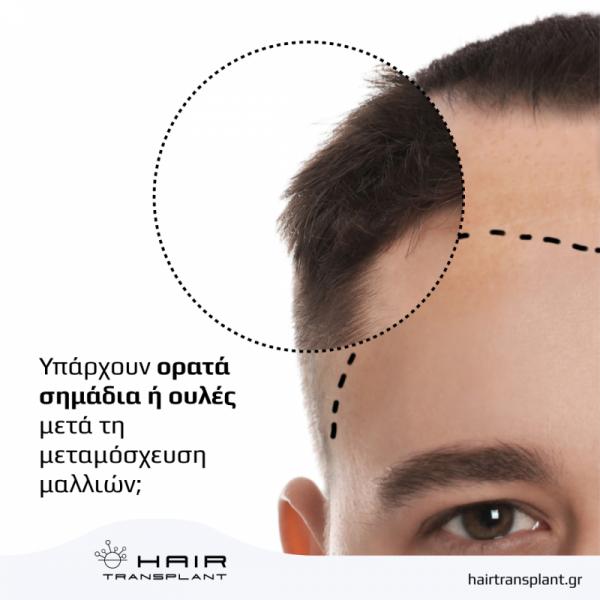 hairtransplant.gr Κέντρο μεταμόσχευσης μαλλιών