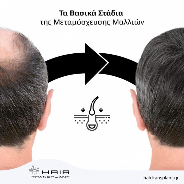 hairtransplant.gr Κέντρο μεταμόσχευσης μαλλιών