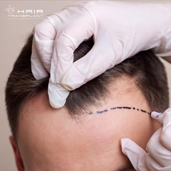 hairtransplant.gr Κέντρο μεταμόσχευσης μαλλιών