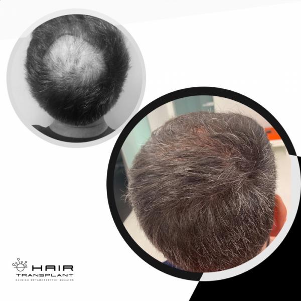hairtransplant.gr Κέντρο μεταμόσχευσης μαλλιών